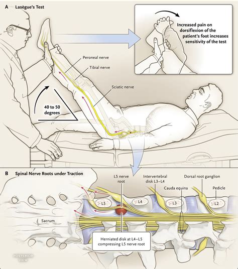 sciatica compression test|sciatic nerve block test.